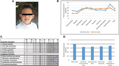 Narrowing the Genetic Causes of Language Dysfunction in the 1q21.1 Microduplication Syndrome